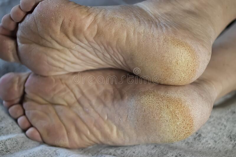 Diabetes Foot Exam and hyperkeratosis