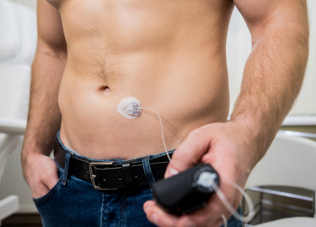 Diabetic Man Wearing insulin pump